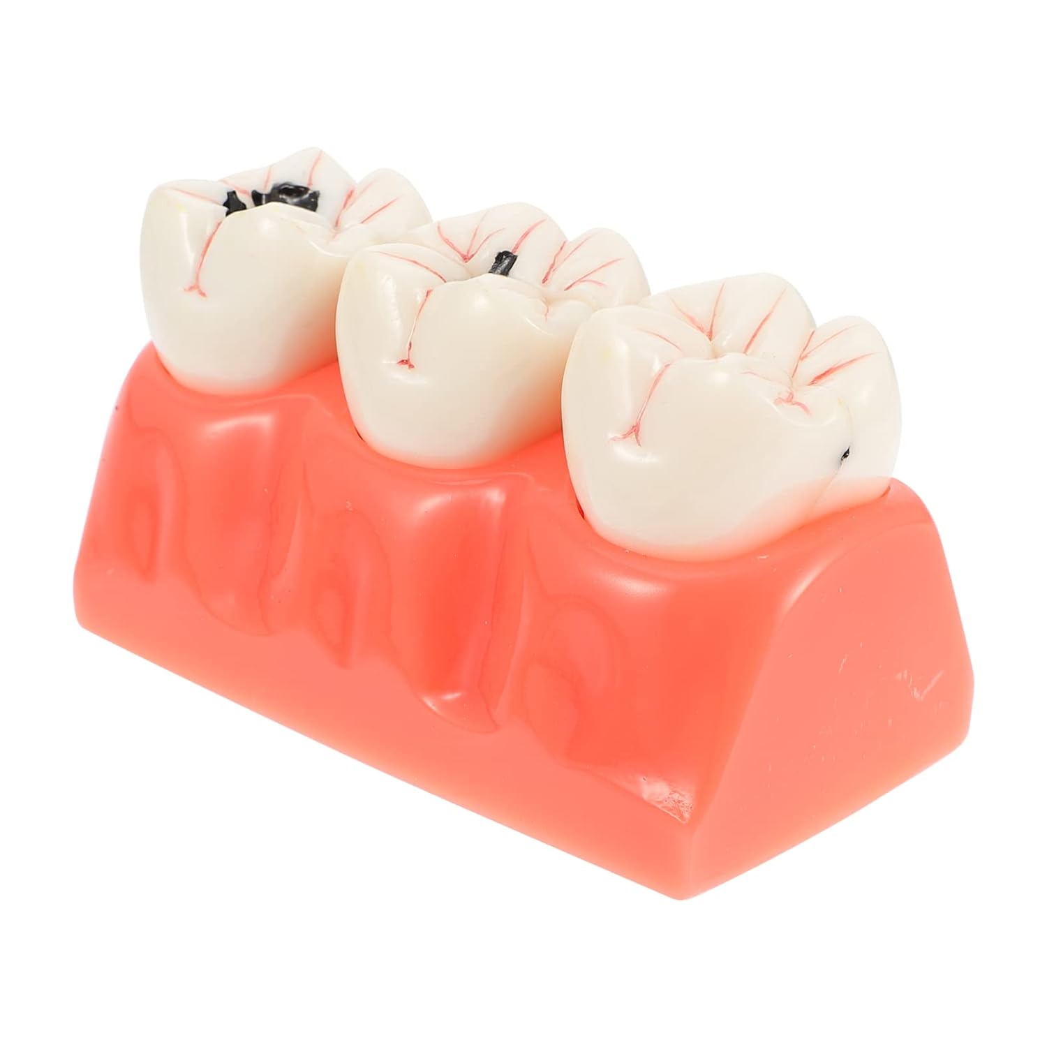ULTECHNOVO 1pc Tooth Decay Model Teeth Model for Education Patient Communication Teaching Tool for Oral School Lessons Restoration Treatment Demonstration