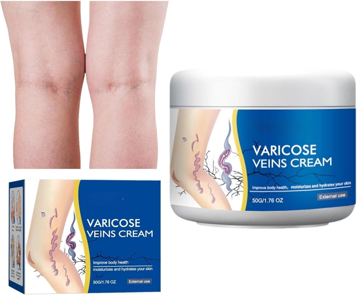 Varicose Veins Cream Varicose Veins Treatment For Legs(1PCS)