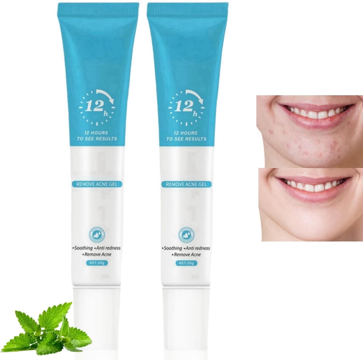 2PCS Acne Treatment Gel, Anti-Acne Cream for Women, Dark Spot Remover for Face, Repair Shrink Pores, Moisturizing Gel