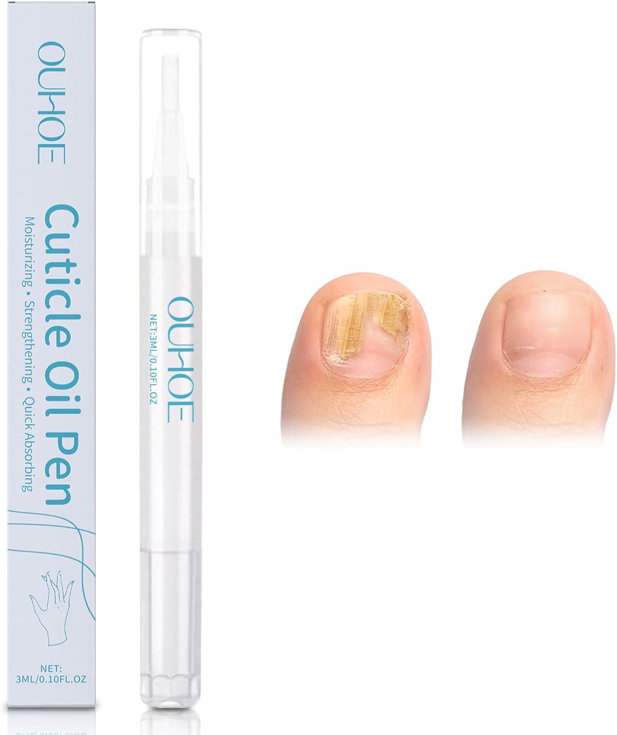 Nail Care Pen 3ml, Nail Treatment Serum, Nail strengthener, Toe Nail Softener, Lubricates Nail & Softens Callouses, Moisturizing Thick Nail & Cracked Toenail, Helps Keep Foot & Hand Nails Beautiful