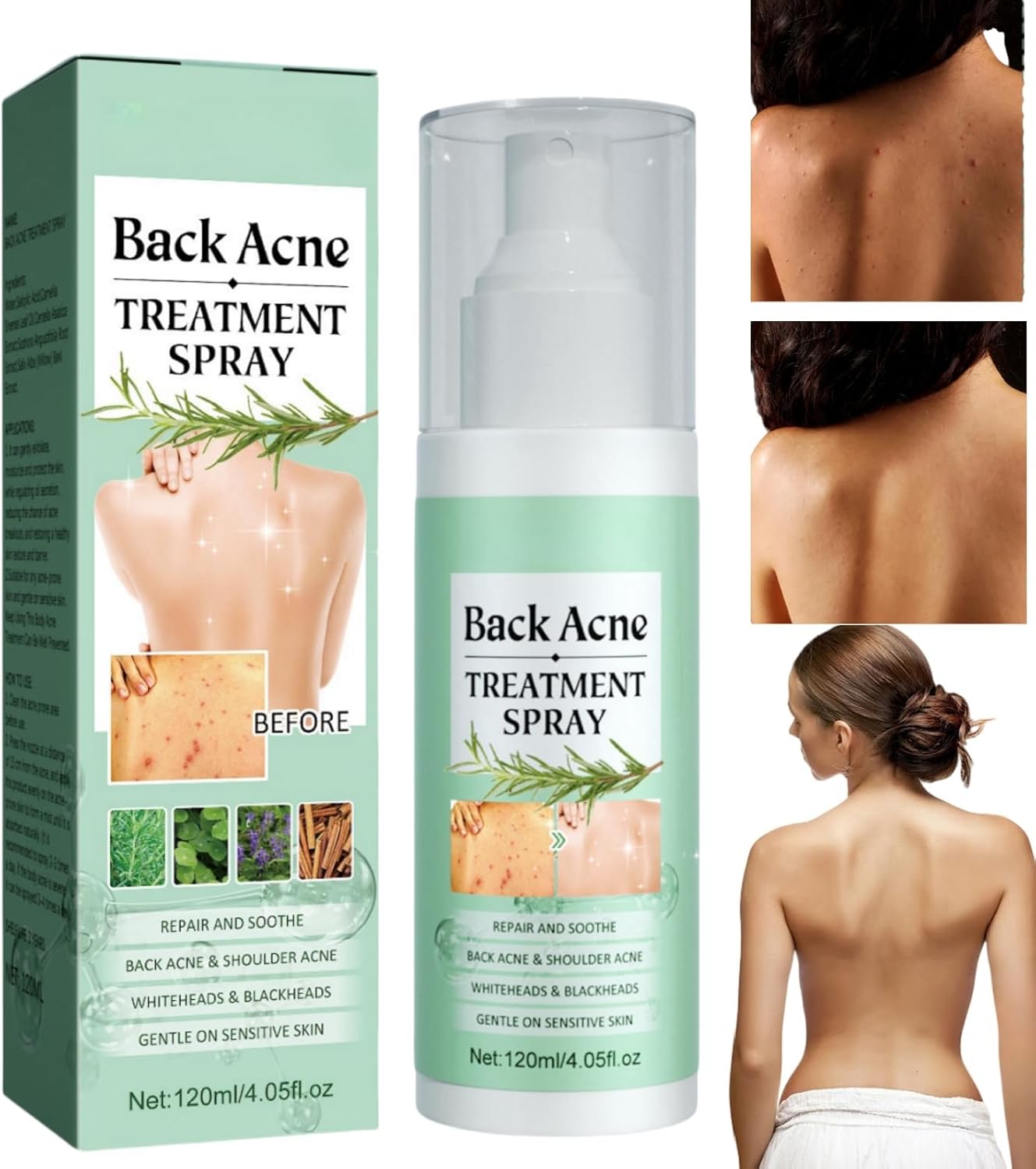 Acne Treatment Spray for Back & Body - 120ml