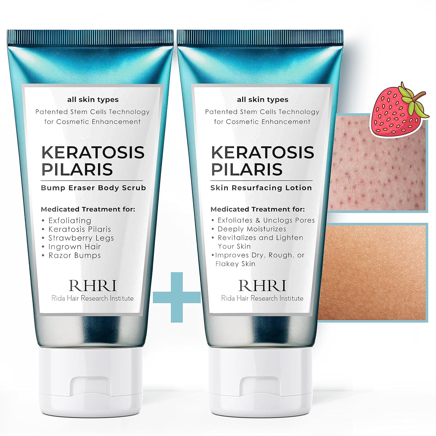 KP Bump Eraser Body Set | Keratosis Pilaris Treatment | Keratosis Pilaris Lotion | Exfoliating Body Scrub | Ingrown Hair Treatment | Bundle Set for Bump, Strawberry Legs, Redness, Dry & Flakey Skin